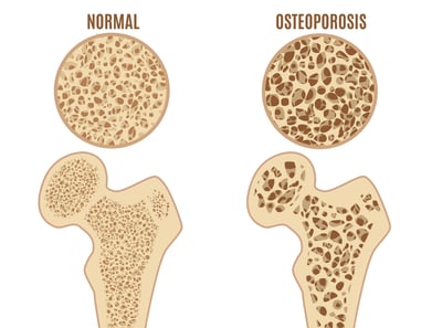 An illustrated diagram shows the difference between normal bones and bones with osteoporosis - which have porous features