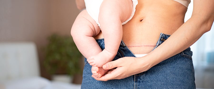 Moms abdomen after cesarean section