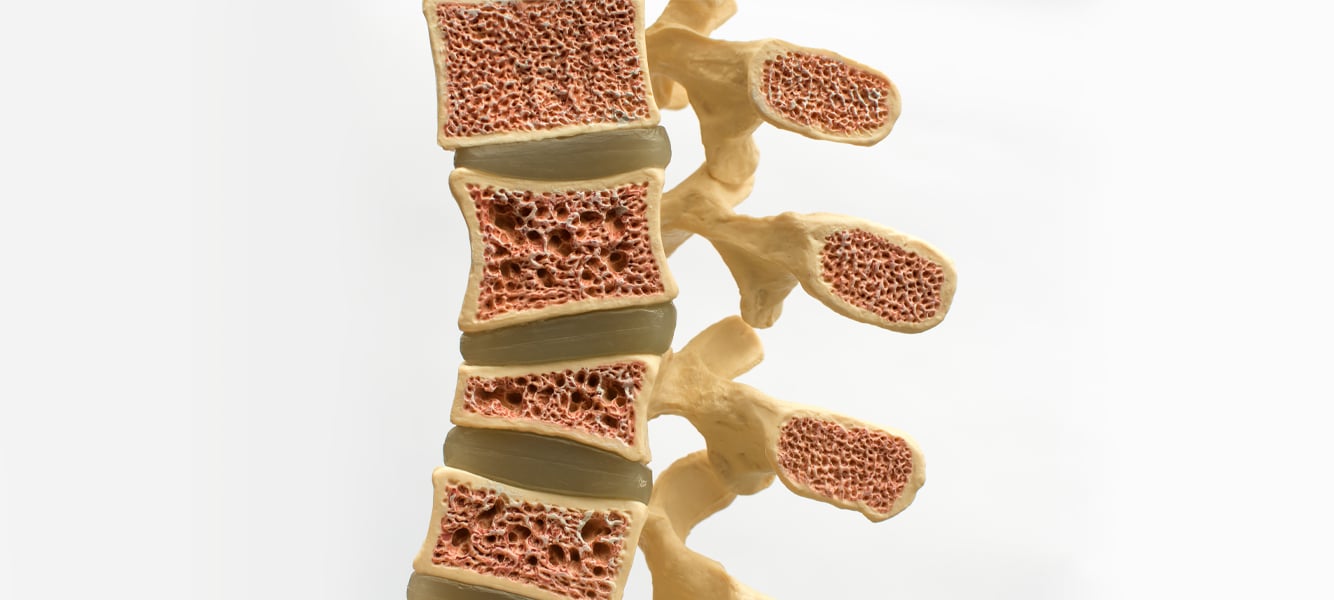 Osteoporosis
