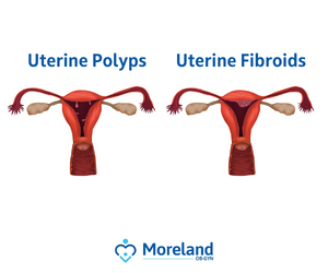 Polyps vs Fibroids Diagram